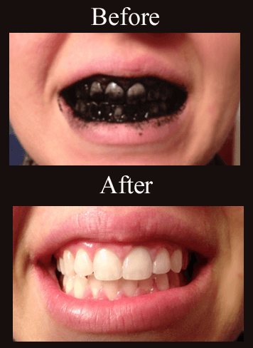 How to Whiten Teeth With Charcoal | Wellness Mama