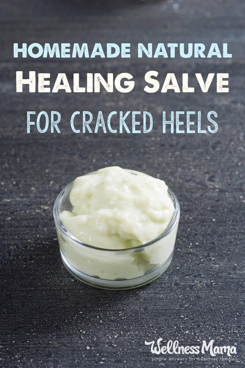 Crackedheels can be frustrating and painful. These homemade remedies like detoxifying foot soaks, supplements and DIY salve can help cracked heels.